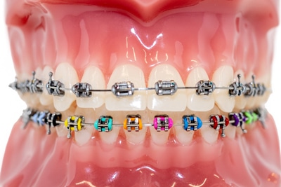 Types of braces Decatur IL